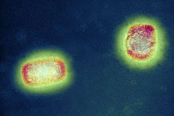 اختبار المستضد السريع: هل سيصبح Monkeypox ، الذي أهمله العالم ، المرض المعدي التالي؟